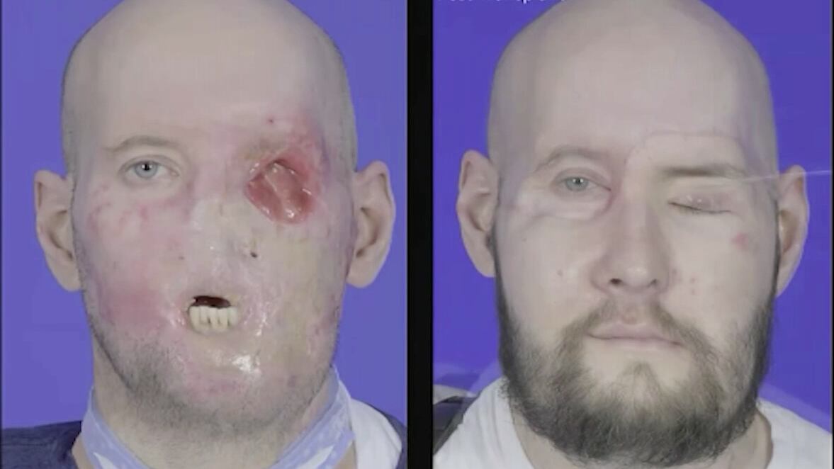 Primer transplante de ojo y rostro humano se realiza con éxito en Estados Unidos